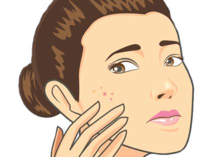 Squeeze Pimples